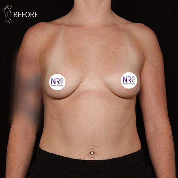 Breast Augmentation before